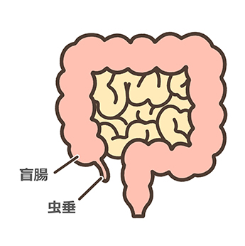 ⾍垂炎（盲腸）とは