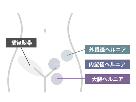 ⿏径ヘルニアの3つの種類