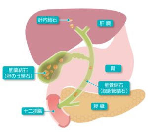 胆石症