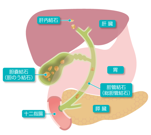 胆石症