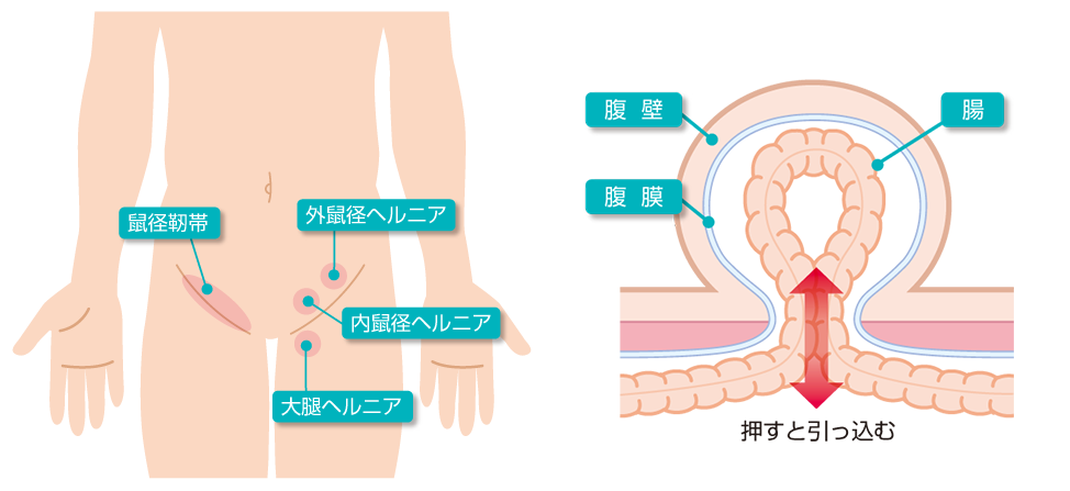 鼠径ヘルニアの3分類